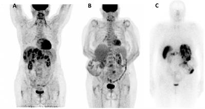 Pasireotide for Refractory Hypoglycemia in Malignant Insulinoma- Case Report and Review of the Literature